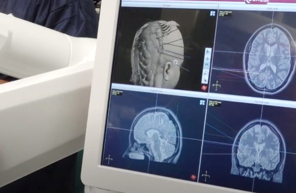 Rosa Device  and  patient Imaging