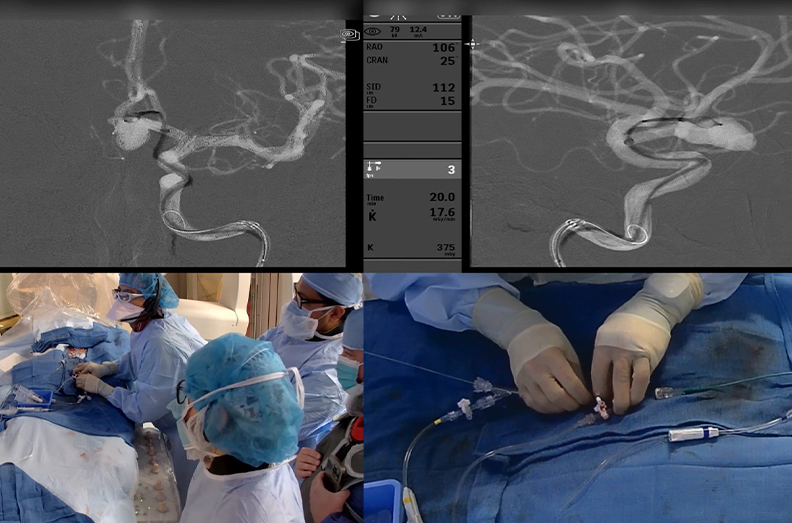 Aneurysm treated with Woven EndoBridge (WEB) device